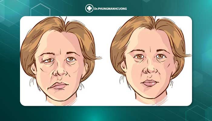 Điều Trị Liệt Mặt Ngoại Biên An Toàn, Hiệu Quả 100% 24 Liệt dây thần kinh số 7 là gì?