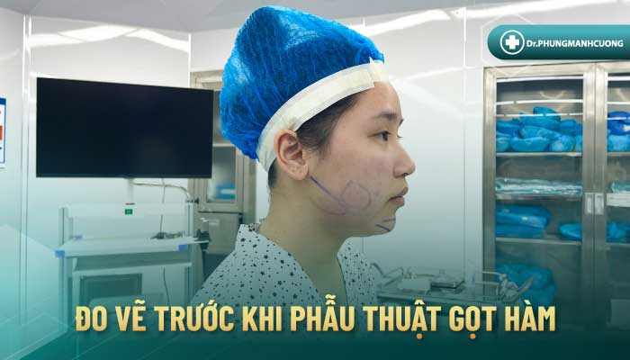 Gọt Hàm Để Dáng Cằm V Line - Thon Gọn Mặt Không Thô Cứng 19 Bác sĩ Cường sẽ đo vẽ tỉ lệ hàm cần gọt