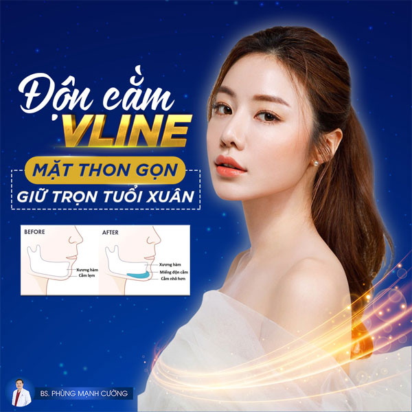 Độn Cằm Hàn Quốc cho mặt thon gọn