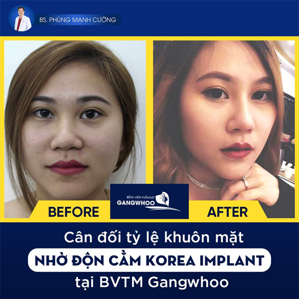 KH Độn Cằm (Korea Implant)