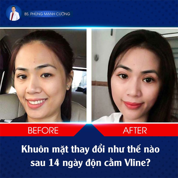 KH Độn Cằm (Korea Implant)