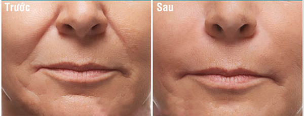 Độn Rãnh Mũi Má Xóa Bỏ Vết Tích Thời Gian Trên Gương Mặt 9 Độn Rãnh Mũi Má - Làm Đầy Rãnh Cười