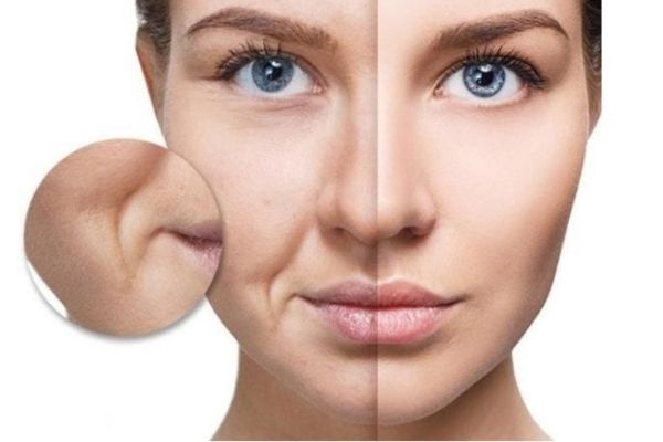 Độn Rãnh Mũi Má Xóa Bỏ Vết Tích Thời Gian Trên Gương Mặt 11 Độn Rãnh Mũi Má Đẩy Lùi Lão Hóa