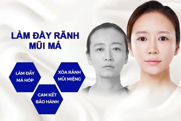 Độn Rãnh Mũi Má Xóa Bỏ Vết Tích Thời Gian Trên Gương Mặt 12 Độn Rãnh Mũi Má Trẻ Hóa Nụ Cười