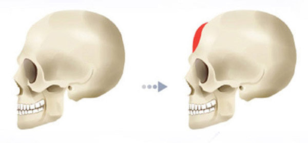 Độn Trán Giúp Trán Nâng Cao, Cải Thiện Tương Số