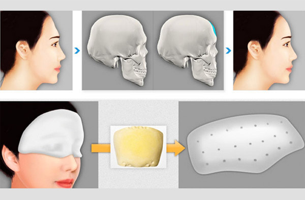 Các Phương Pháp Độn Trán