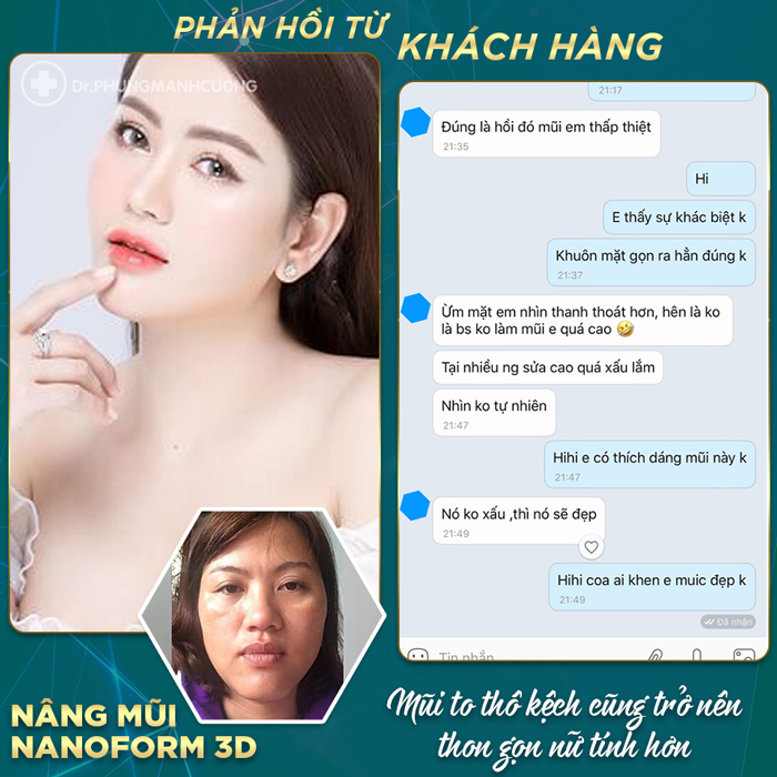 KH si mê với nâng mũi nanoform