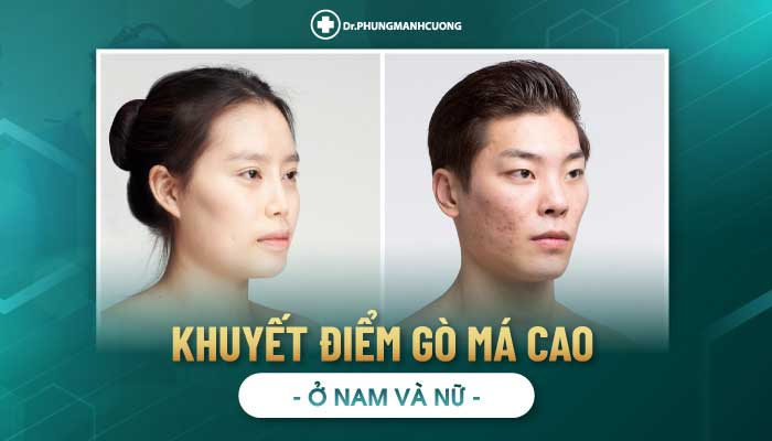 Các đối tượng nên thực hiện hạ gò má