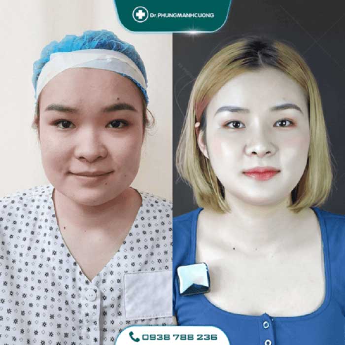 Gọt Hàm Để Dáng Cằm V Line - Thon Gọn Mặt Không Thô Cứng 24 got ham 1