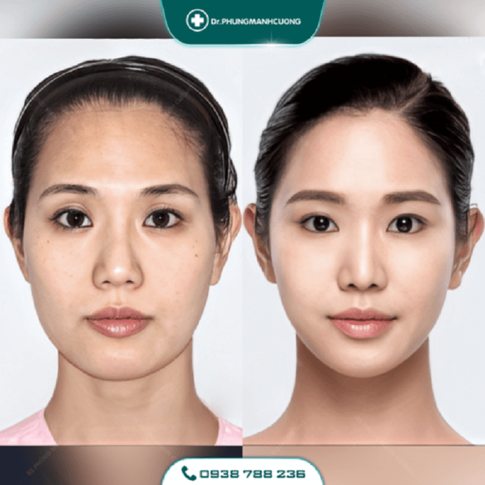 Gọt Hàm Để Dáng Cằm V Line - Thon Gọn Mặt Không Thô Cứng 28 got ham 1