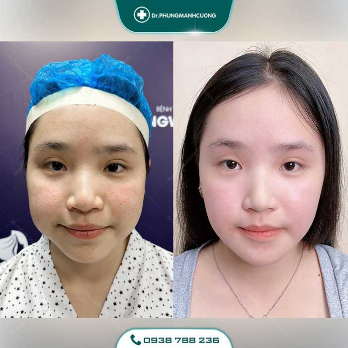 Gọt Hàm Để Dáng Cằm V Line - Thon Gọn Mặt Không Thô Cứng 23 got ham