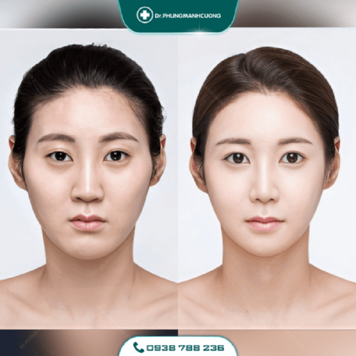 Gọt Hàm Để Dáng Cằm V Line - Thon Gọn Mặt Không Thô Cứng 27 got ham 2