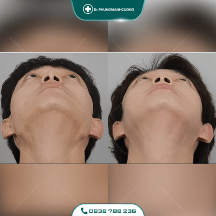 Gọt Hàm Để Dáng Cằm V Line - Thon Gọn Mặt Không Thô Cứng 25 got ham 4