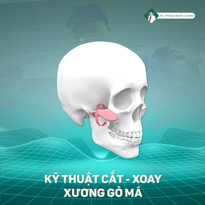 Mô phỏng kỹ thuật hạ gò má tại BS Phùng Mạnh Cường