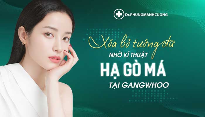 Phẫu thuật hạ gò má giúp thon gọn khuôn mặt