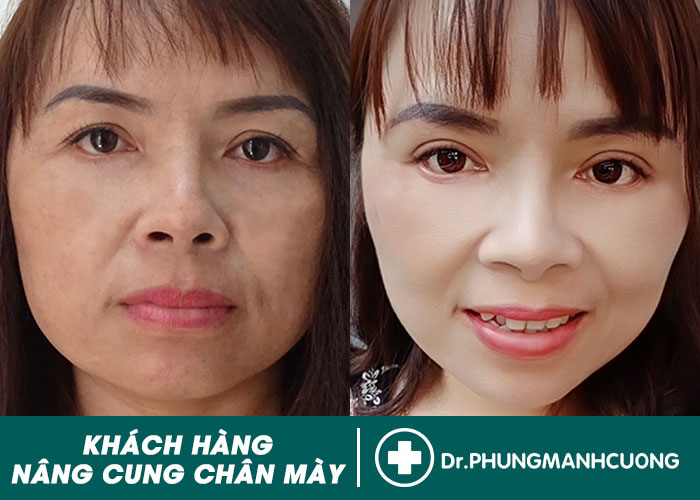 HÌNH ẢNH KHÁCH HÀNG NÂNG CUNG CHÂN MÀY NỘI SOI ĐẸP TẠI BS.PHÙNG MẠNH CƯỜNG