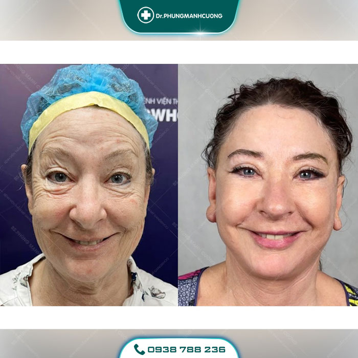 Căng Da Mặt Trẻ Hóa Bằng Chỉ Firin Nano Collagen Lấy Lại Thanh Xuân, Xóa Mờ Nếp Nhăn 31 hinh cang da bsc 29