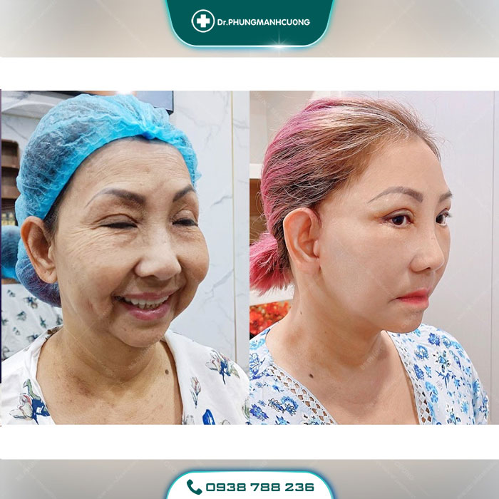 Căng Da Mặt Trẻ Hóa Bằng Chỉ Firin Nano Collagen Lấy Lại Thanh Xuân, Xóa Mờ Nếp Nhăn 30 hinh cang da bsc 30