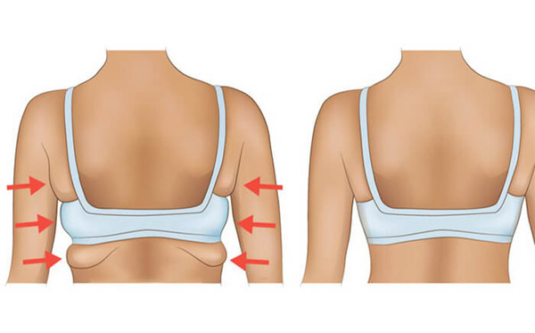 Hút Mỡ Lưng Cho Tấm Lưng Thon Gọn