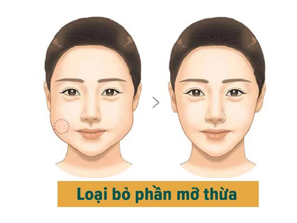 Hút Mỡ Mặt, Hút Mỡ Má Cho Khuôn Mặt Thon Gọn V Line 13 Hút Mỡ Mặt Cho Khuôn Mặt Thon Gọn