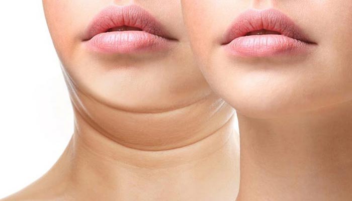 Hút Mỡ Nọng Cằm - Lấy Mỡ Cho Khuôn Mặt Thanh Tú 10 Hút Mỡ Nọng Cằm - Lấy Mỡ Cho Khuôn Mặt Thanh Tú