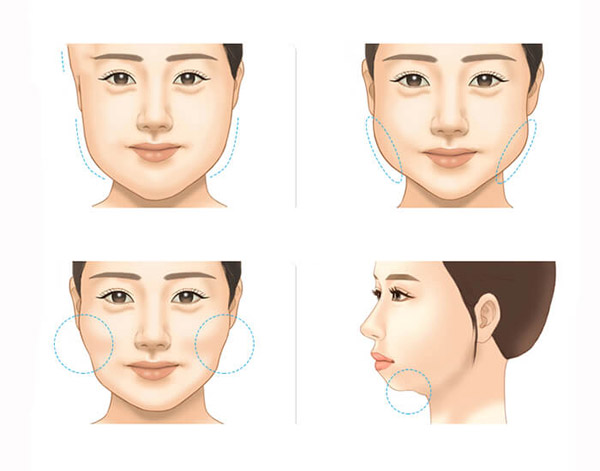 Hút Mỡ Nọng Cằm - Lấy Mỡ Cho Khuôn Mặt Thanh Tú 12 Hút Mỡ Nọng Cằm - Phương pháp giảm mỡ an toàn