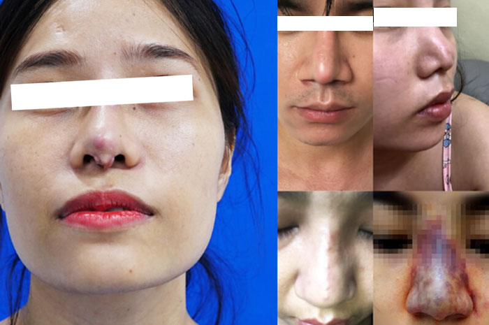 Những trường hợp mũi hỏng bị lộ sụn