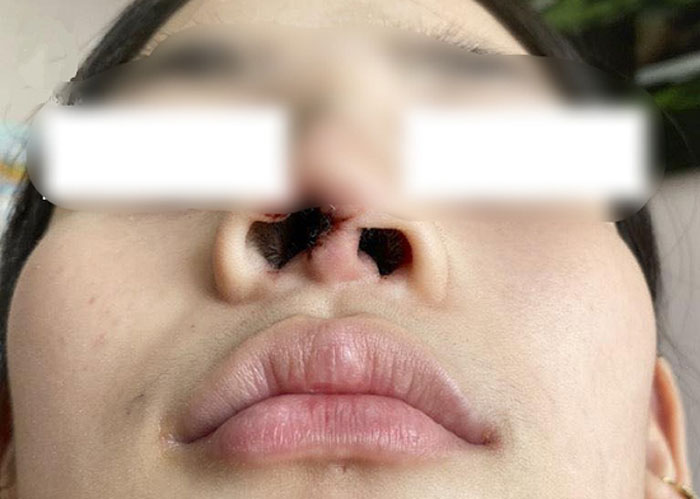 Hình ảnh mũi hỏng bị biến dạng gây mất thẩm mỹ