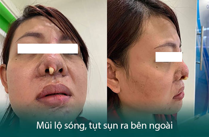 HÌNH ẢNH KHÁCH HÀNG NÂNG MŨI BỊ HOẠI TỬ Ở THẨM MỸ VIỆN KHÔNG UY TÍN