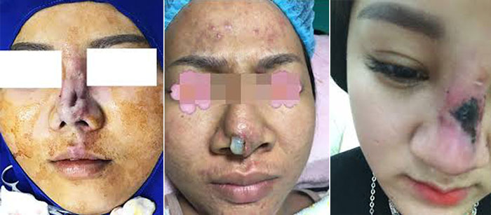 Trường hợp mũi bị hỏng nặng, biến dạng và hoại tử