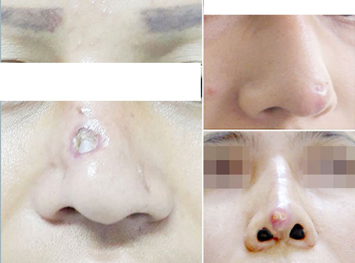 HÌNH ẢNH KHÁCH HÀNG NÂNG MŨI BỊ HOẠI TỬ Ở THẨM MỸ VIỆN KHÔNG UY TÍN