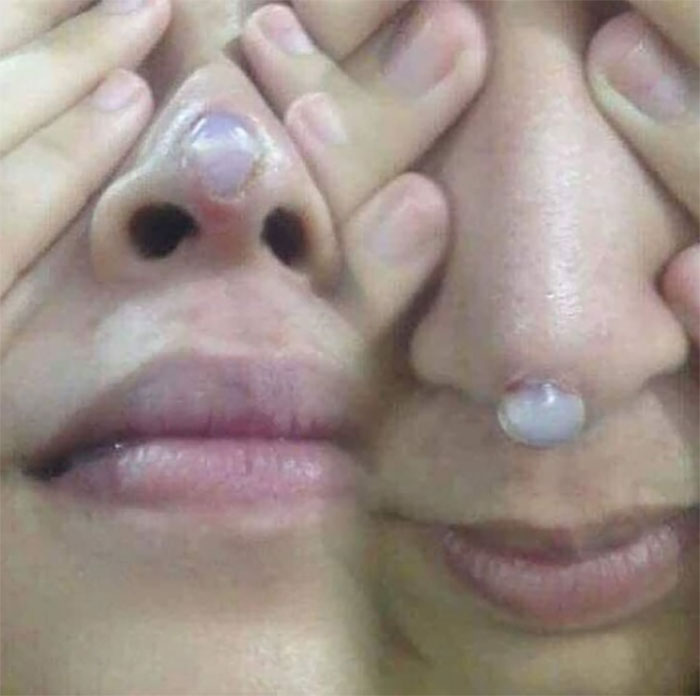 Mũi bị hỏng do sụn đẩm thủng da đầu mũi