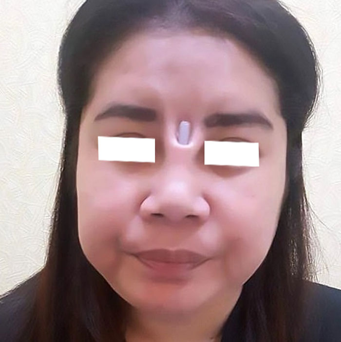 Mũi hỏng do sụn quá cứng, gây thủng da mũi, lòi sụn