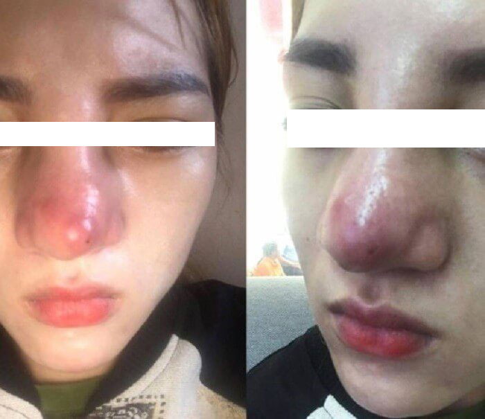 Hình ảnh mũi phù nề, tụ dịch ở bên trong