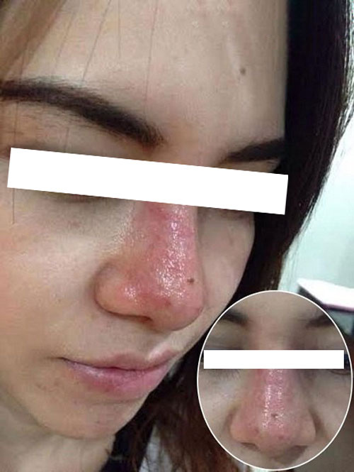 Trường hợp mũi hỏng sưng đỏ, phù nề toàn bộ