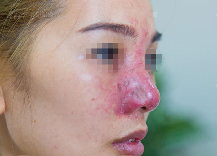 Mũi hỏng bị sưng tấy tỏ, có dấu hiệu tím đen