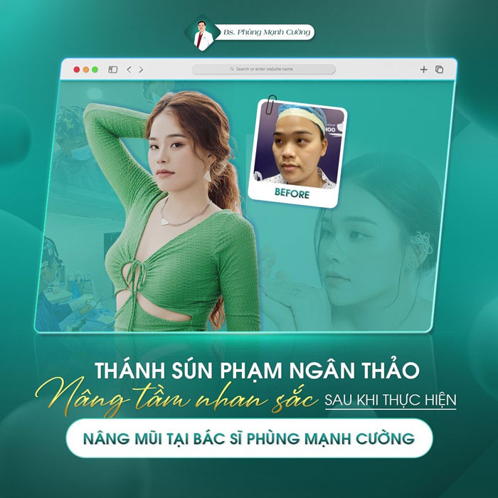Hình ảnh khách hàng nâng mũi S line đẹp lung linh