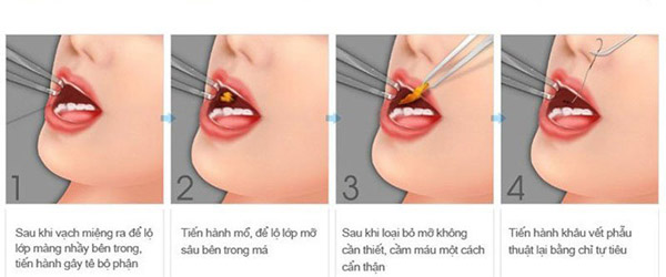 Phương Pháp Lấy Mỡ Má 2 Bên Nội Soi