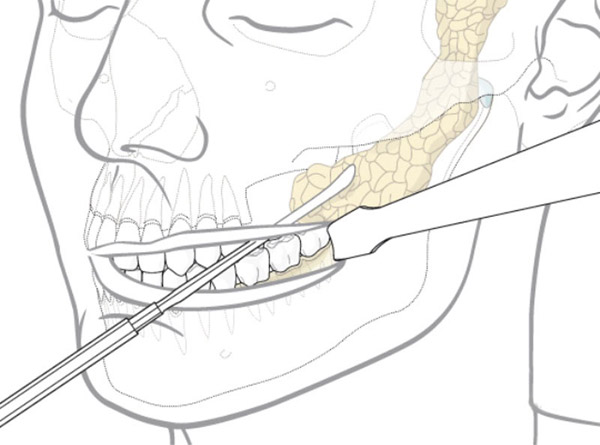 Tiểu Phẫu Lấy Mỡ Má 2 Bên Nội Soi