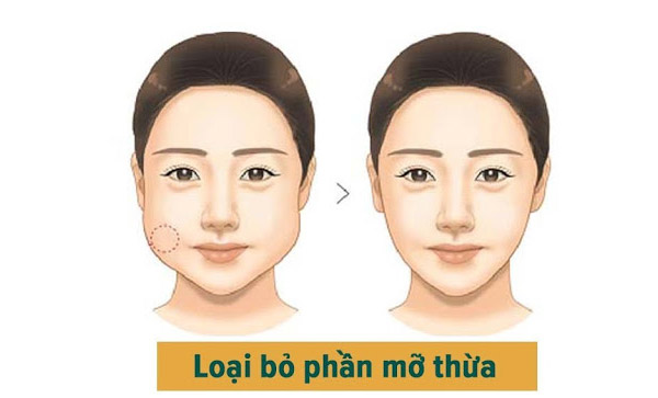 Lấy Mỡ Má 2 Bên Nội Soi An Toàn