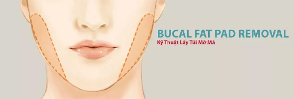 Lấy Mỡ Má 2 Bên Nội Soi Lấy lại Khuôn Mặt Cân Đối