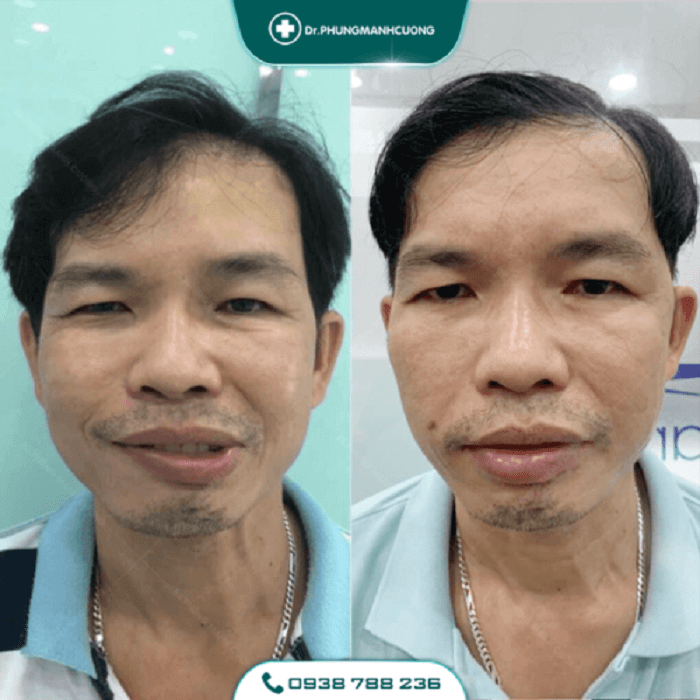 Điều Trị Liệt Mặt Ngoại Biên An Toàn, Hiệu Quả 100% 40 liet mat1