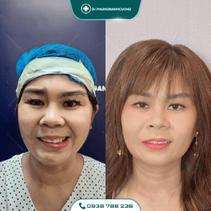 Điều Trị Liệt Mặt Ngoại Biên An Toàn, Hiệu Quả 100% 39 liet mat2