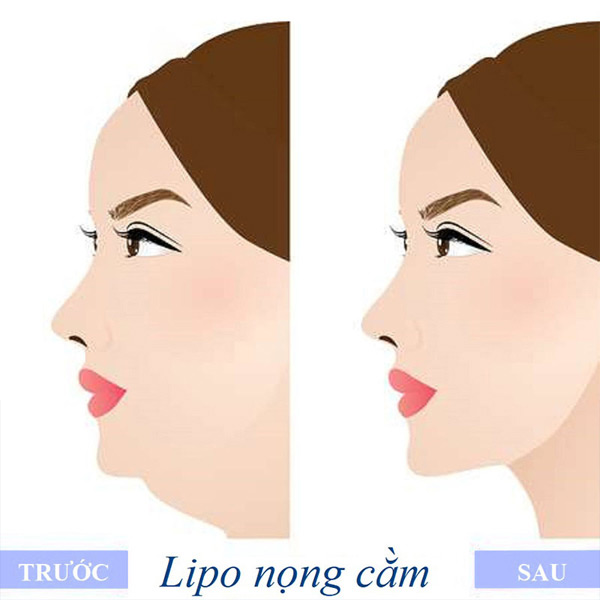 Mất Nọng Cằm Với Dịch Vụ Lipo Nội Soi