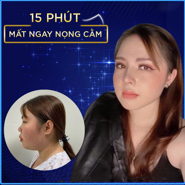 Lipo Nội Soi Nọng Cằm Lazer