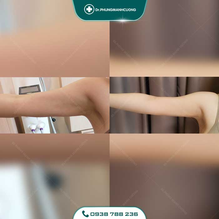 Cánh tay khách hàng thon gọn sau khi thực hiện hút mỡ tại BS Cường