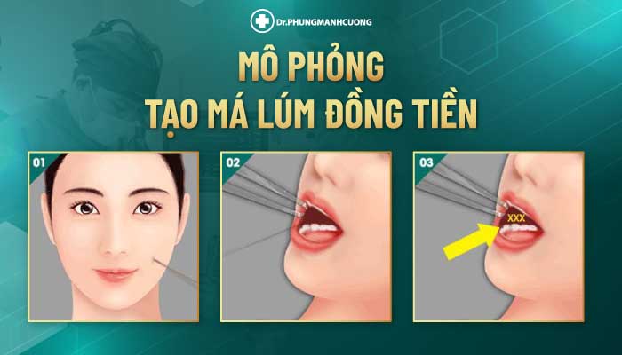 Mô Phỏng tạo má lúm đồng tiền tại BS Cường