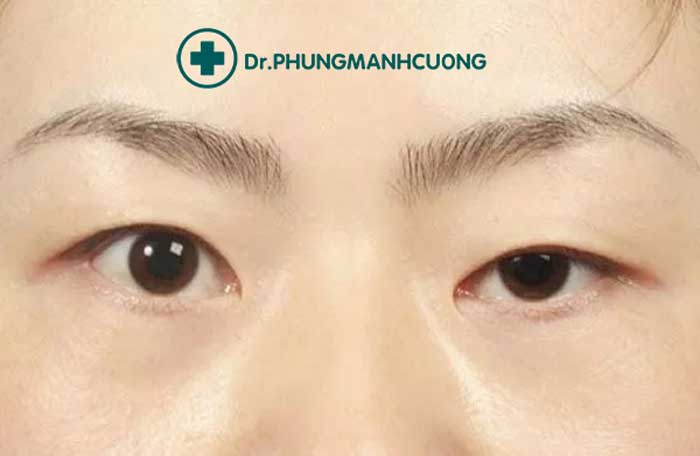 Chuyên Gia Sửa Mí Mắt Hỏng - Giải Cứu Thảm Họa Thẩm Mỹ 19 mắt bị lệch