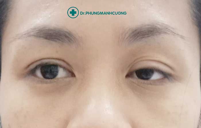 Chuyên Gia Sửa Mí Mắt Hỏng - Giải Cứu Thảm Họa Thẩm Mỹ 20 Mí mắt bị sâu, bị sụp