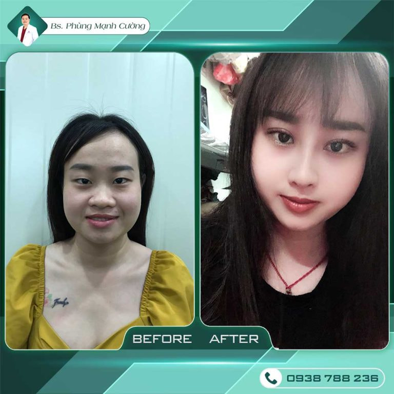 Cắt mí mắt 4 trong 1 Plasma - Khắc phục các khuyết điểm khó